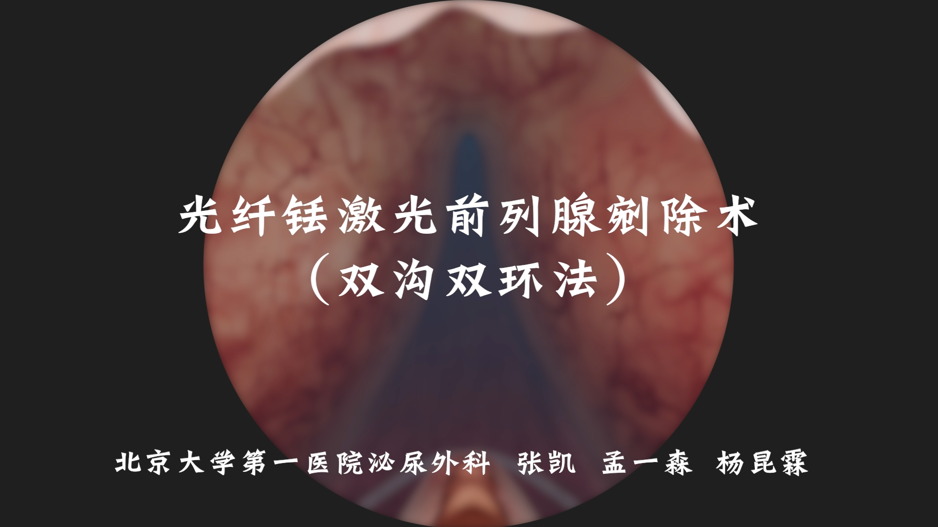 光纤铥激光前列腺剜除术 双沟双环法