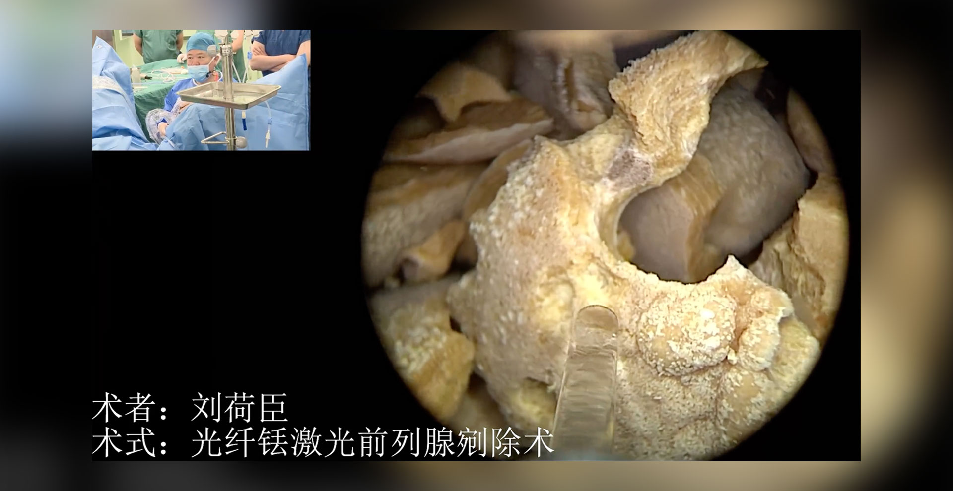 光纤铥激光前列腺剜除术-刘荷臣