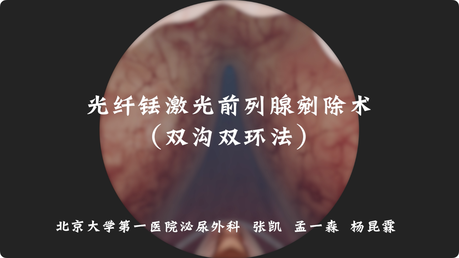 光纤铥激光前列腺剜除术