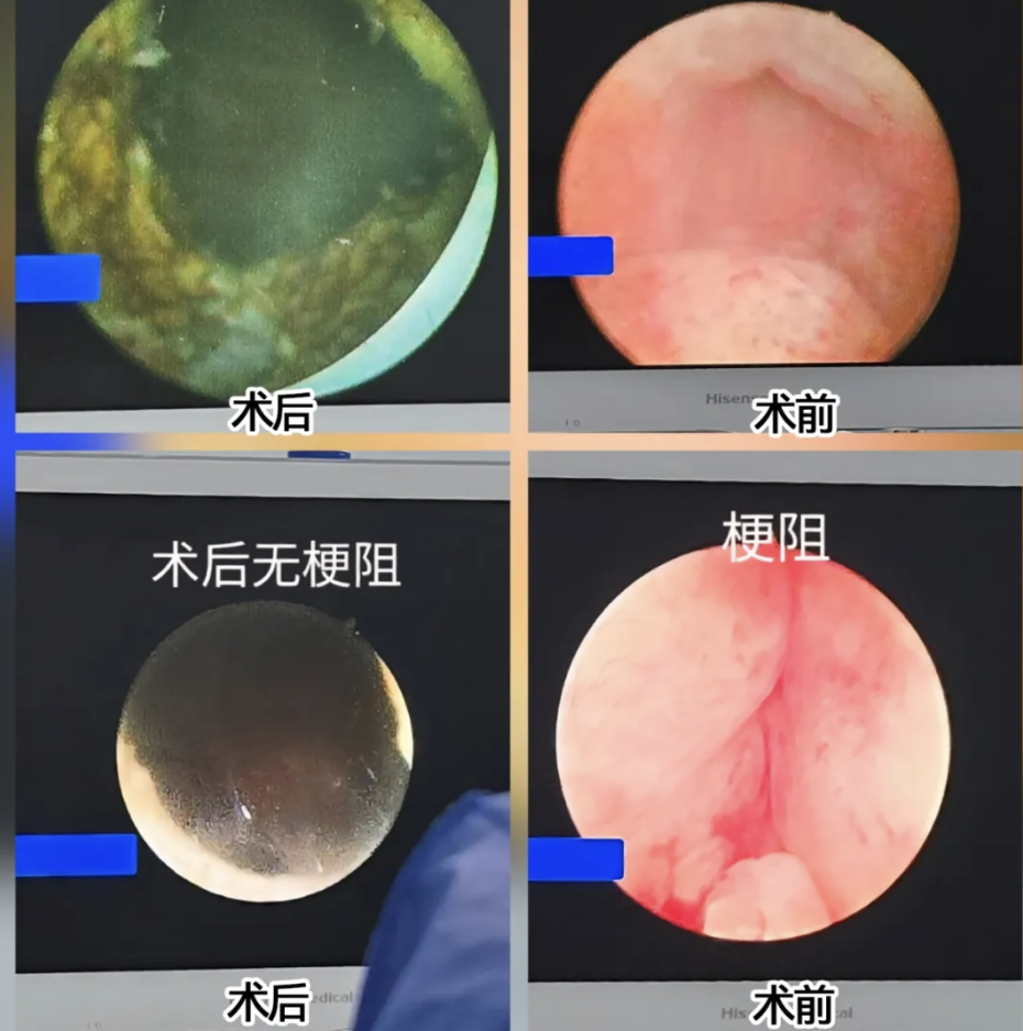 一天出院，不易复发！瑞柯恩铥激光助力山西医科大学第一医院开展前列腺增生日间手术